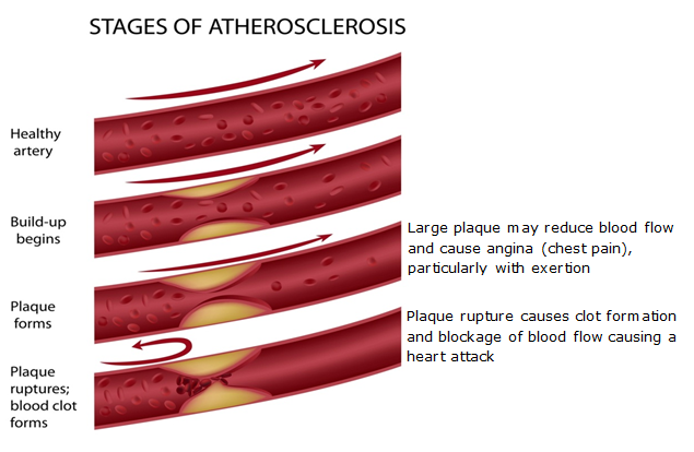 LightBox-2-Causes-Stages of Atherosclerosis