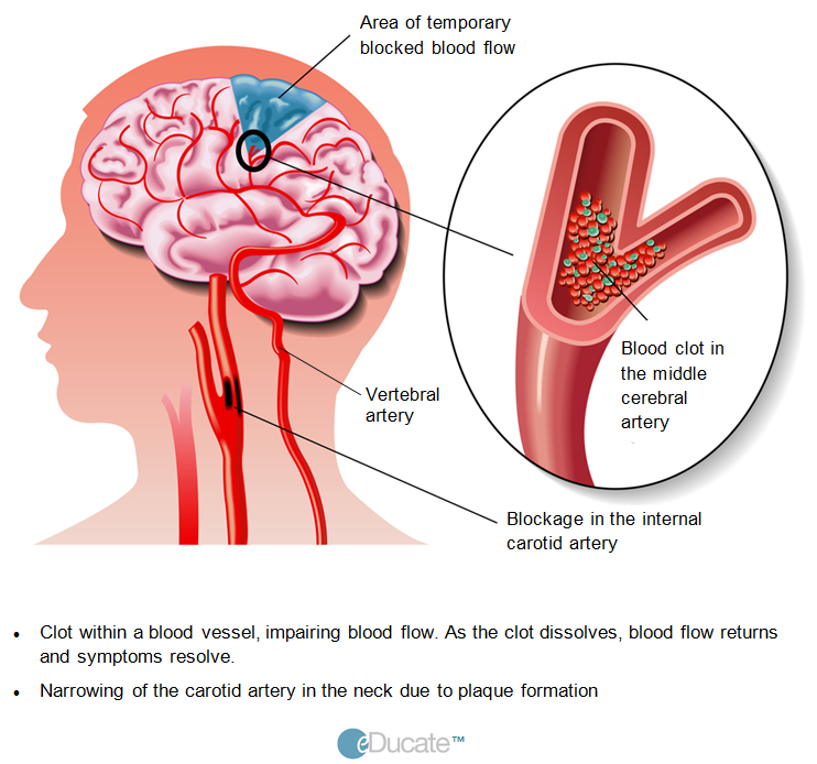 TIA-Cartid Artery-Definition