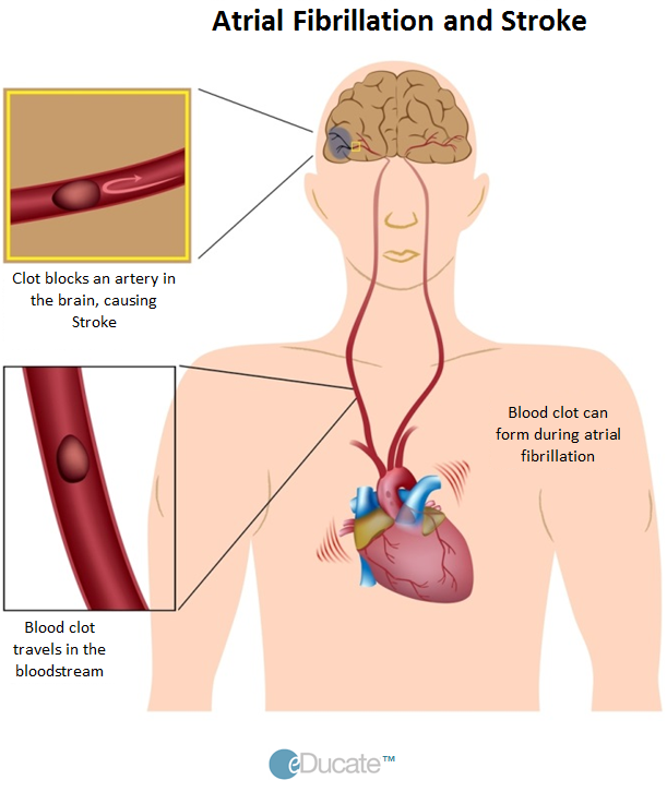 Patient-TIA-Treatment-AF and stroke