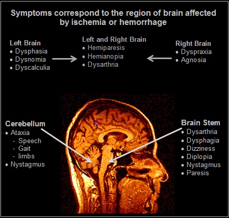 Clinical presentation of ischmeic stroke