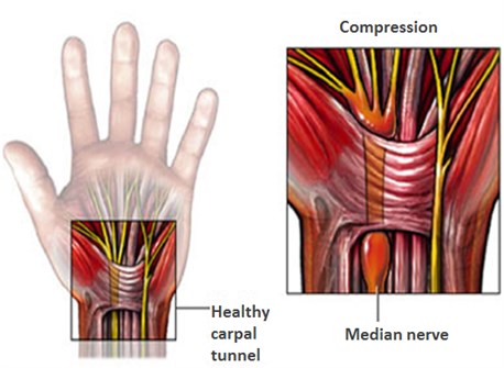 1-Image-CTS-Definition-Healthy carpal tunnel