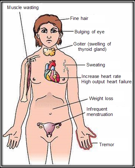 1-Image-Symptoms-Clinical features-Hyperthyroid