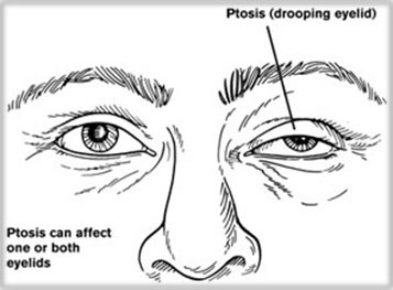 1-Image-Symptoms-Ptosis