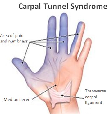 2-Image-CTS-Symptoms-Area of pain