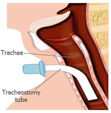 3-Image-Tracheostomy tube-ALS-Patient