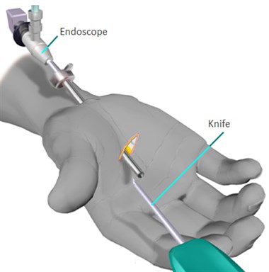 4-Image-CTS-Treatment-Endoscope