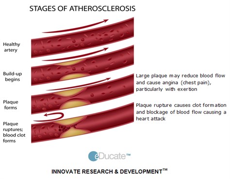 LightBox-2-Causes-Stages of Atherosclerosis